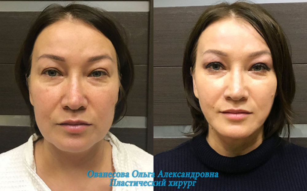 Фото до и после липосакции подбородка у пластического хирурга Ольги Ованесовой