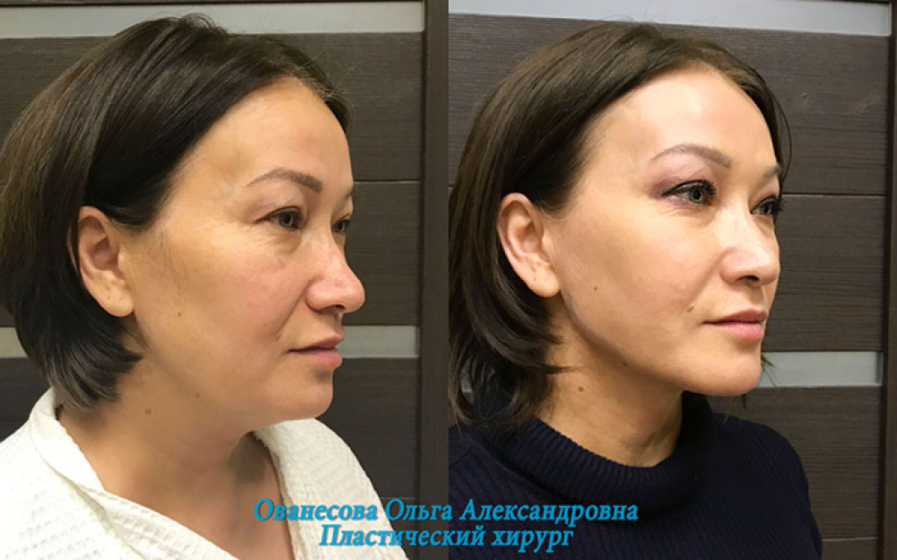 Пациентка до и после липосакции подбородка у пластического хирурга Ольги Ованесовой