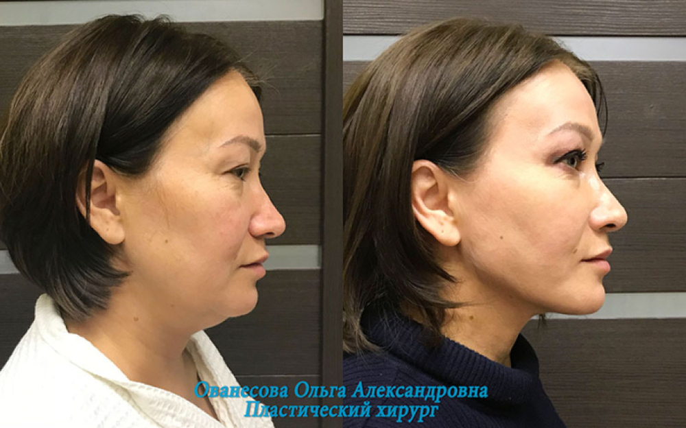 Пациентка на фото до и после липосакции подбородка у пластического хирурга Ольги Ованесовой