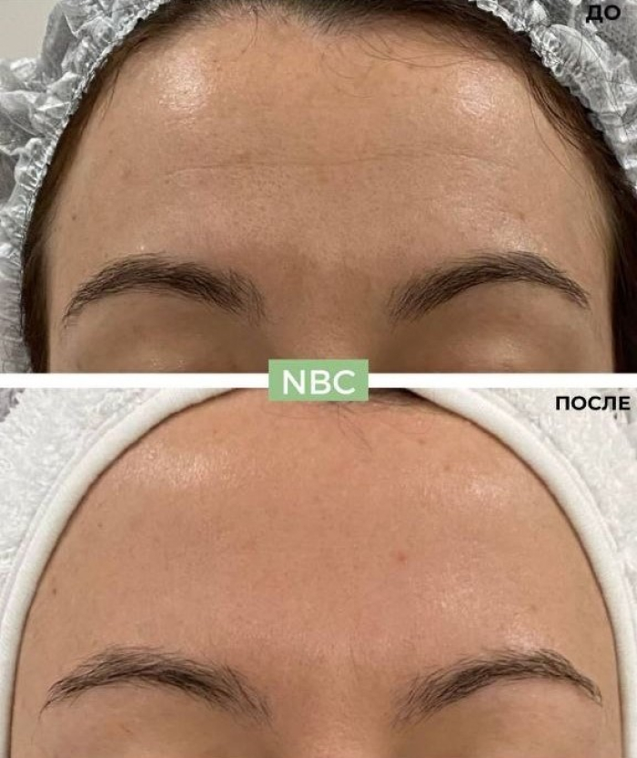 Пациентка клиники NBC до и после косметологических процедур