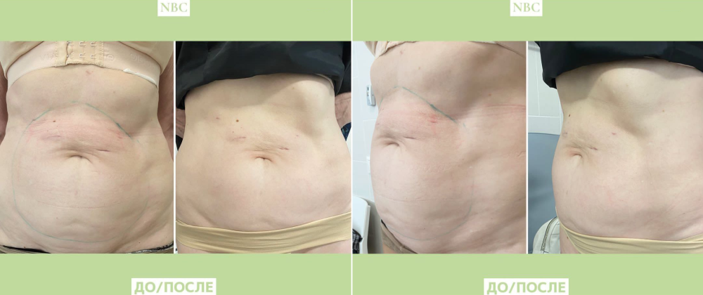 Пациентка клиники NBC до и после процедуры Улфит