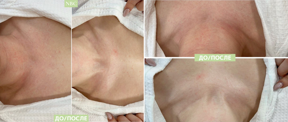 Пациентка клиники NBC до и после процедуры Бионик
