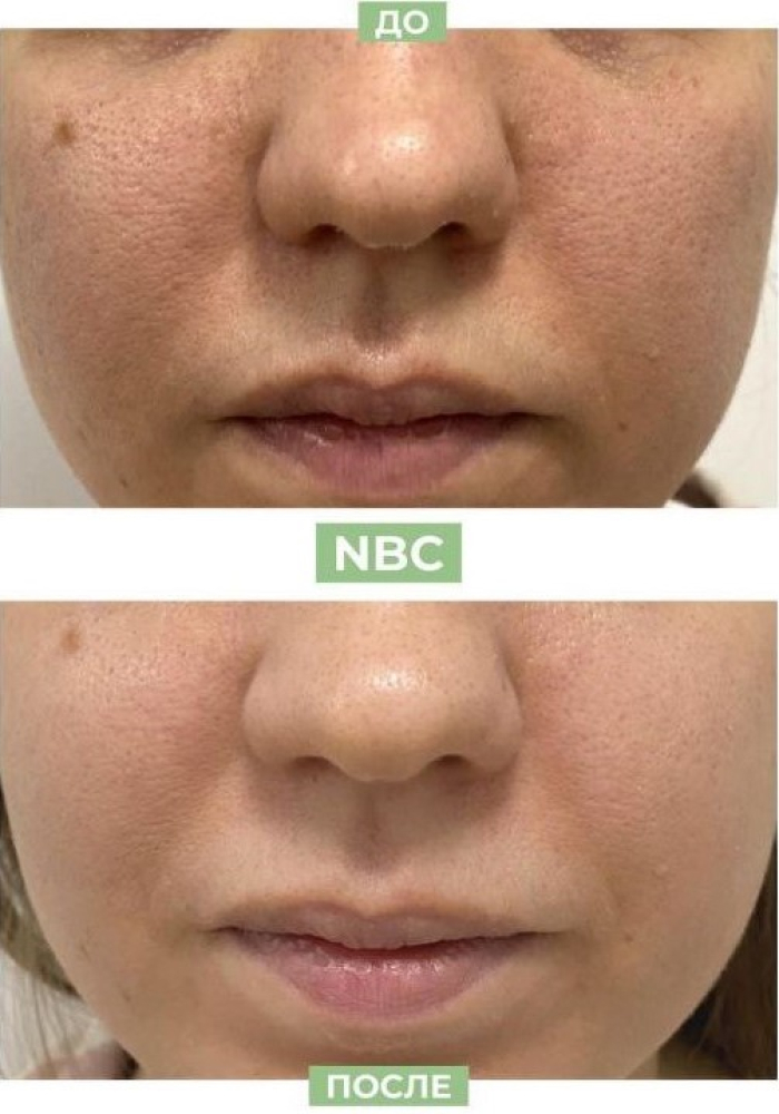 Пациентка клиники NBC до и после косметологических процедур