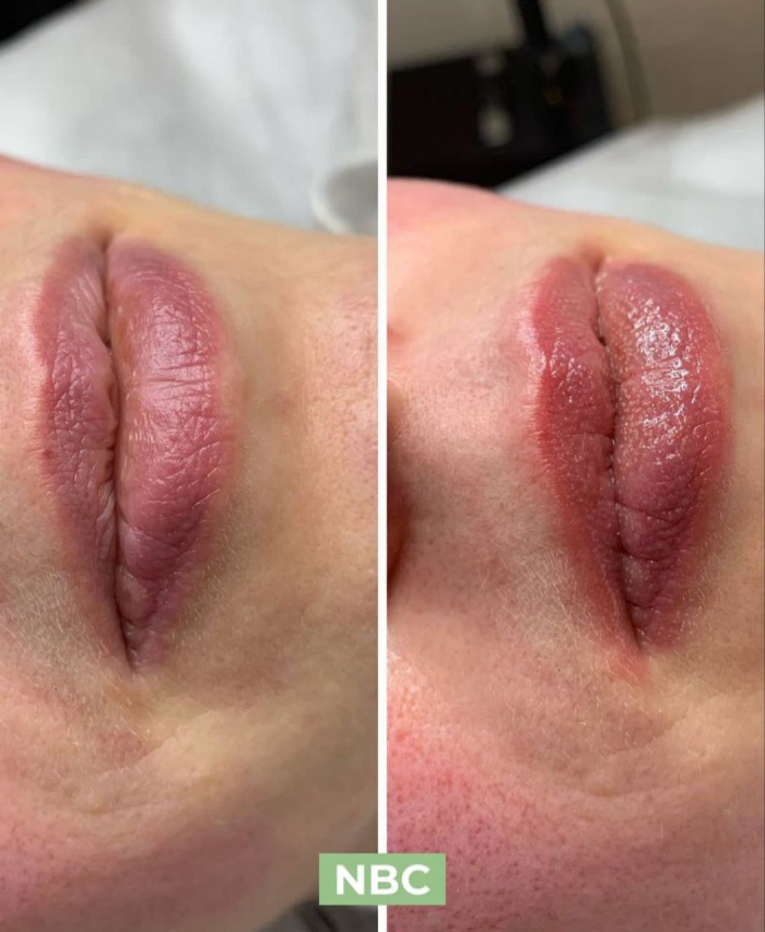 Пациентка клиники NBC до и после косметологических процедур