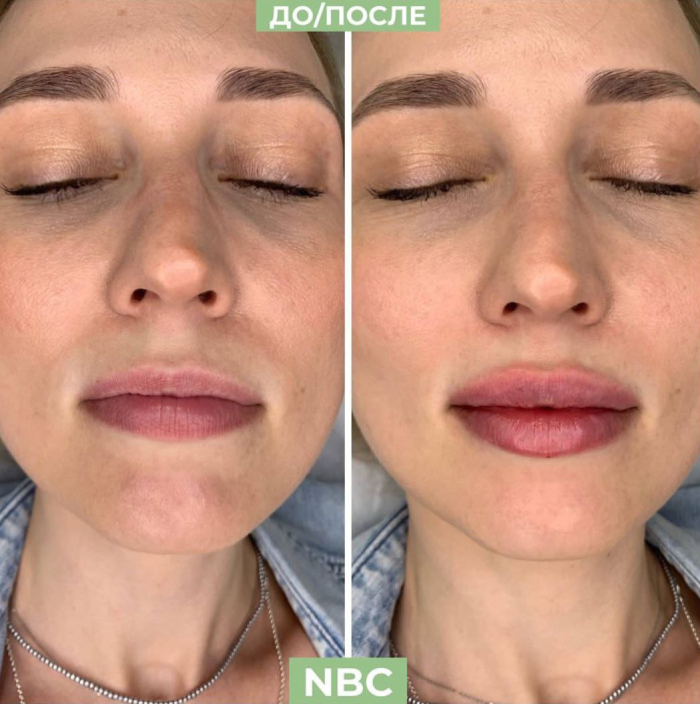 Пациентка клиники NBC до и после увеличения губ