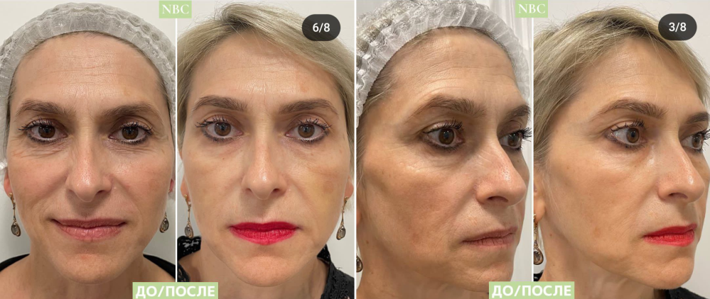 Пациентка клиники NBC до и после аппаратного омоложения