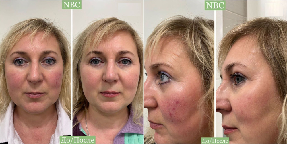 Пациентка клиники NBC до и после косметологических процедур