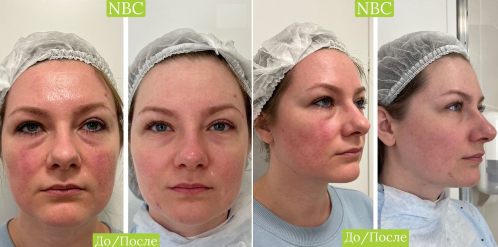 Пациентка клиники NBC до и после косметологических процедур