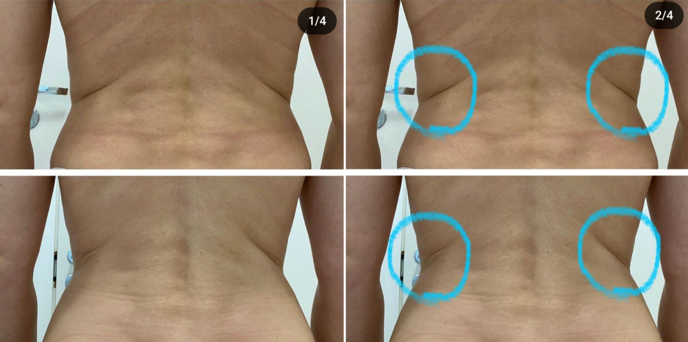 Пациентка клиники NBC до и после процедуры Термолифтинг