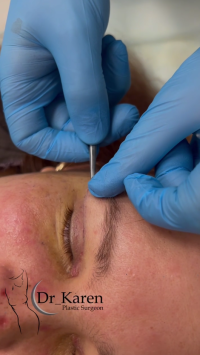 Пластический хирург Карен Пайтян снимает швы после блефаропластики