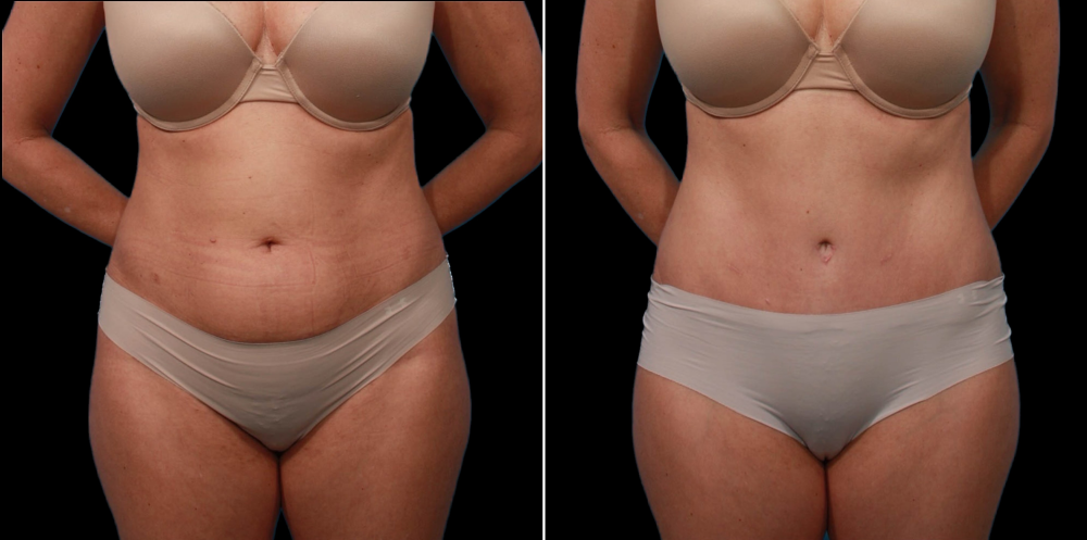 Пациентка пластического хирурга Гукаса Миракяна до и после абдоминопластики с переносом пупка