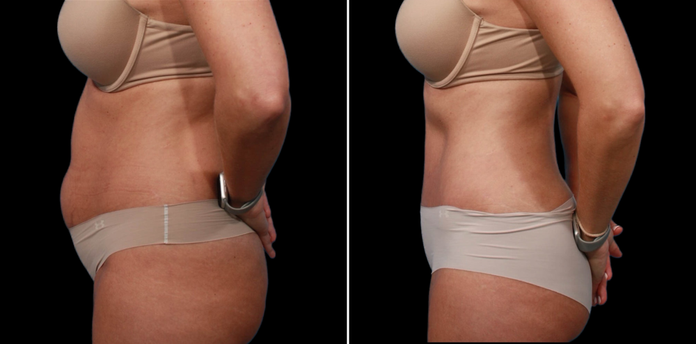 Пациентка пластического хирурга Гукаса Миракяна до и после абдоминопластики.