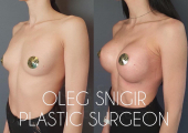 Олег Снигирь. Фото до и после увеличения груди