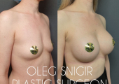 Олег Снигирь. Фото до и после увеличения груди имплантами.