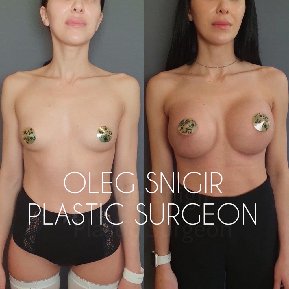Олег Снигирь. Фото до и после увеличения груди в Москве