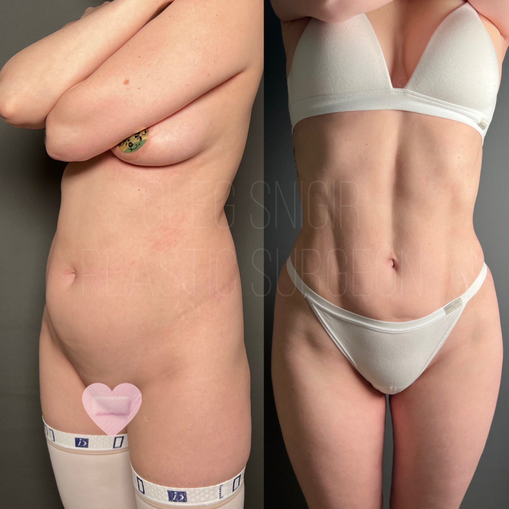 Олег Снигирь. Фото пациентки до и после спортивного липомоделирования и липофилинга ягодиц