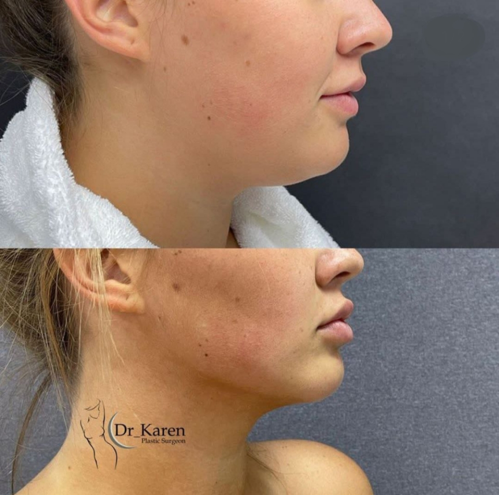 Пациентка доктора Карена Пайтяна до и после удаления комков Биша