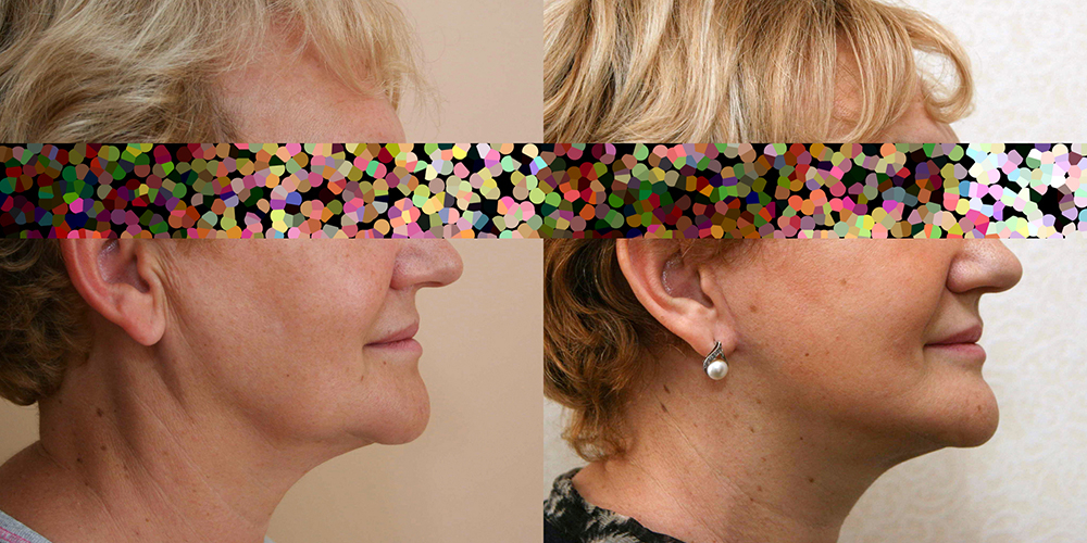 Пациентка пластического хирурга Александра Жукова до и после омолаживающей операции по подтяжке лица.