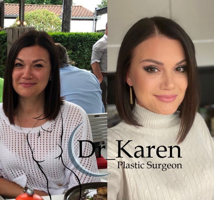 Пациентка до и после липомоделирование подбородка и верхней блефаропластики