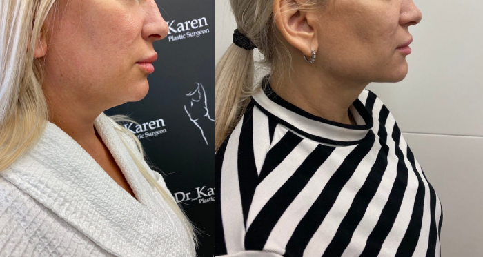 Фото пациентки до и после липомоделирования подбородка