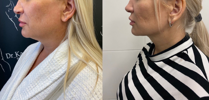 Фото пациентки доктора Карена Пайтяна до и после липомоделирования подбородка