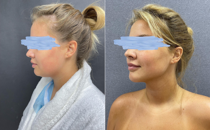 Пациентка доктора Карена Пайтяна до и после ипомоделирование подбородка и удаление комков Биша.