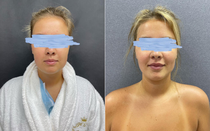 Пациентка доктора Карена Пайтяна до и после ипомоделирование подбородка и удаление комков Биша.