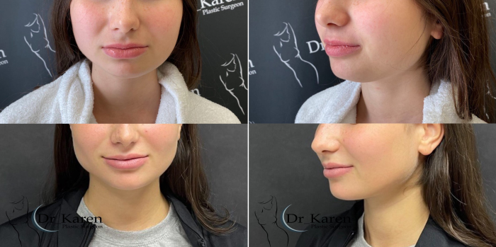 Доктор Карен Пайтян провел пациентке липомоделирование подбородка, удаление комков Биша и v-y пластику верхней губы