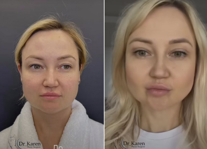 Пациентка хирурга Карена Пайтяна до и после операций: верхняя блефаропластика, липомоделирование подбородка, удаление комков Биша