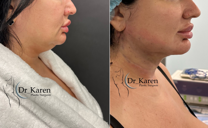 Фото пациентки до и после липомоделирования подбородка