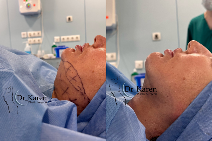 Фото пациентки до и после липомоделирования подбородка у доктора Карена Пайтяна.