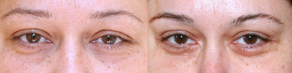 Пациентка пластического хирурга Александра Жукова после блефаропластики