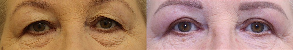 Пациентка пластического хирурга Александра Жукова после блефаропластики