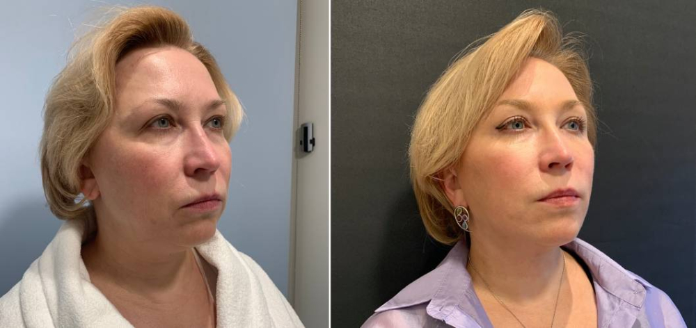 Александр Катков спейслифтинг