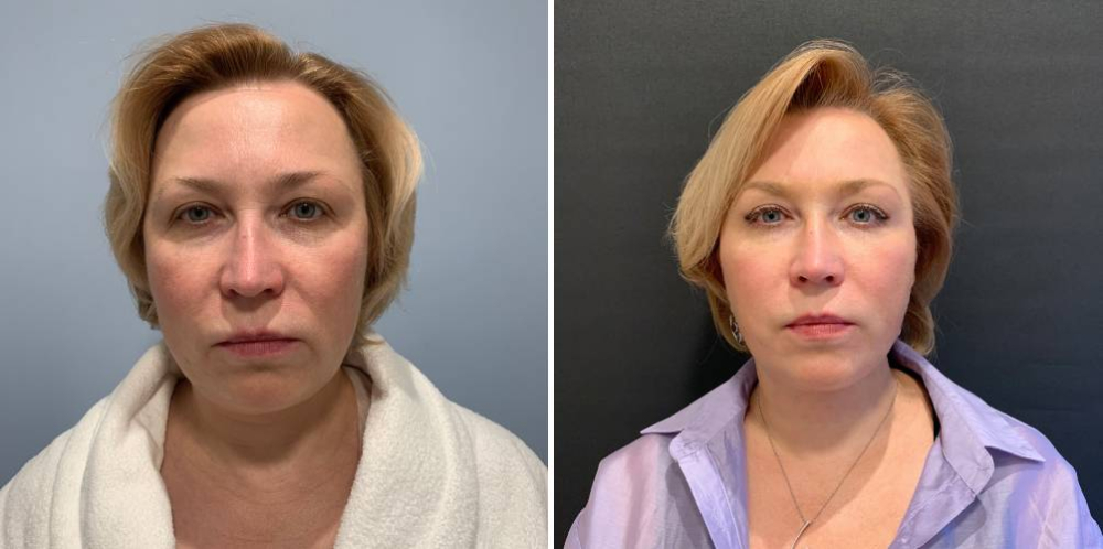 Александр Катков спейслифтинг