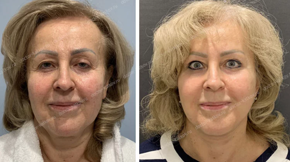 Спейслифтинг фото до и после