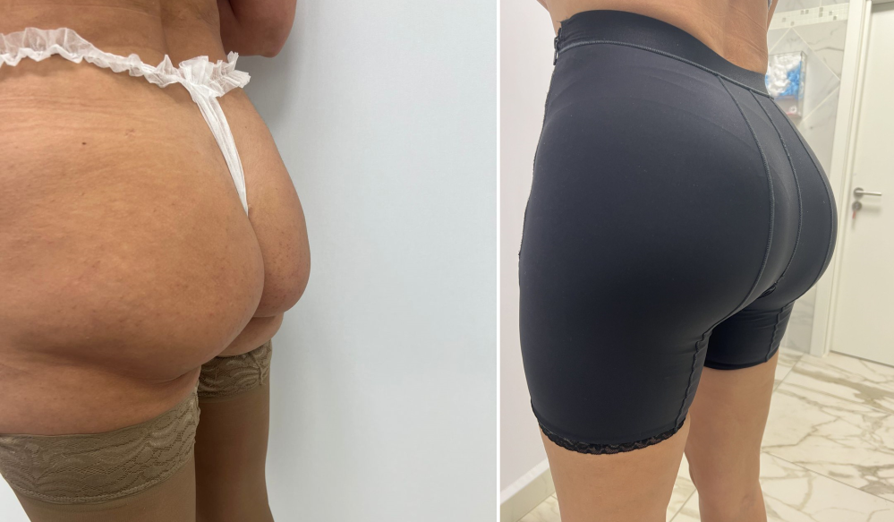 Дмитрий Крысин. Фото пациентки до и после реэндопротезирования ягодиц