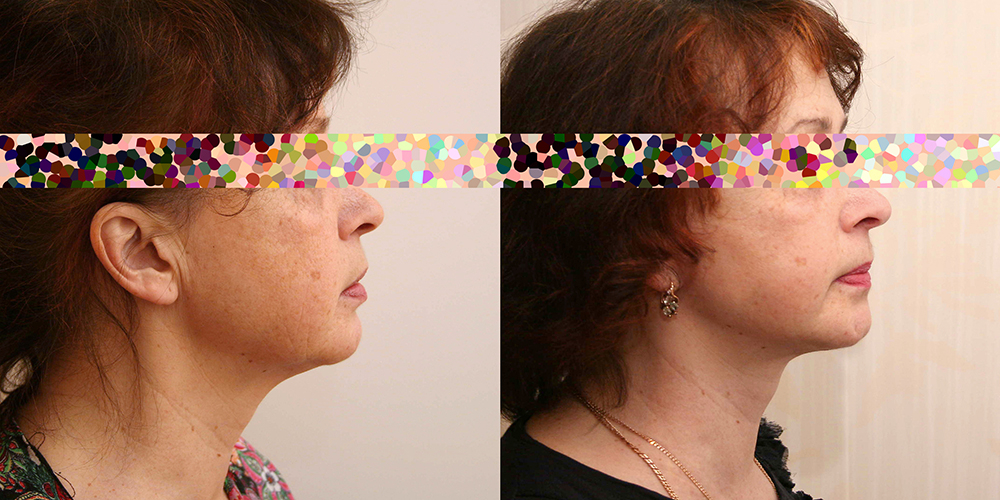 Пациентка пластического хирурга Александра Жукова на фото до и после подтяжки лица и шеи.