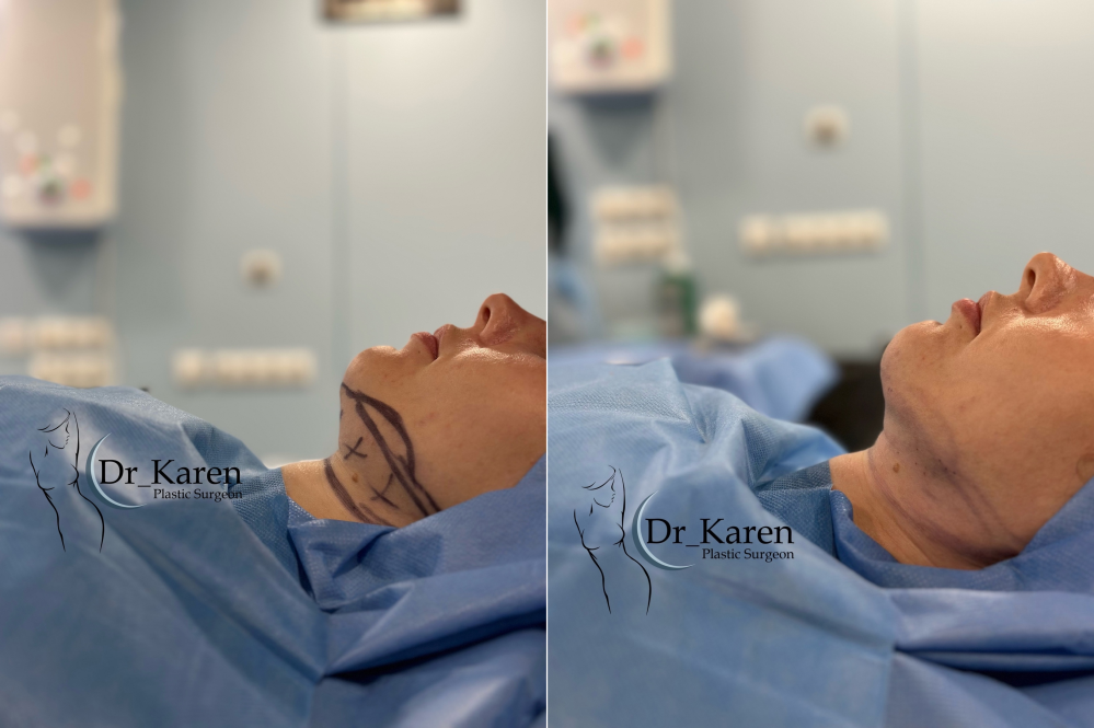 Пациентка пластического хирурга Карена Пайтяна