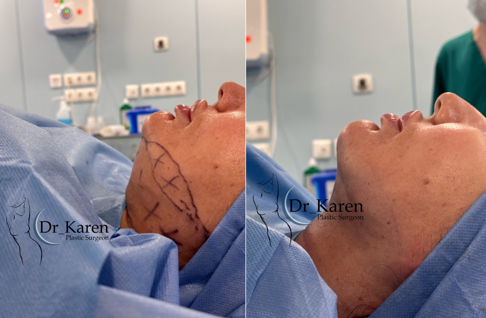 Фото пациентки до и после липомоделирования подбородка у доктора Карена Пайтяна