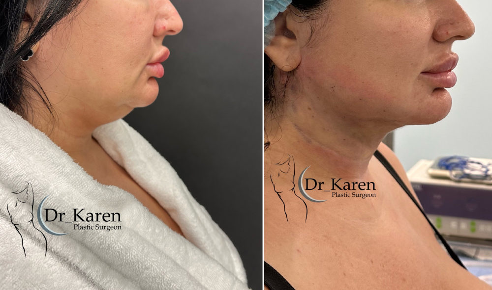Фото пациентки до и после липомоделирования подбородка у хирурга Карена Пайтяна