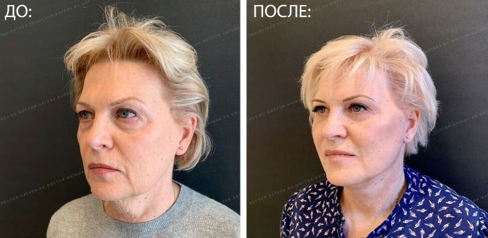 Пациентка пластического хирурга Александра Каткова. Фото до и через два месяца после комплексной омолаживающей операции на лице.