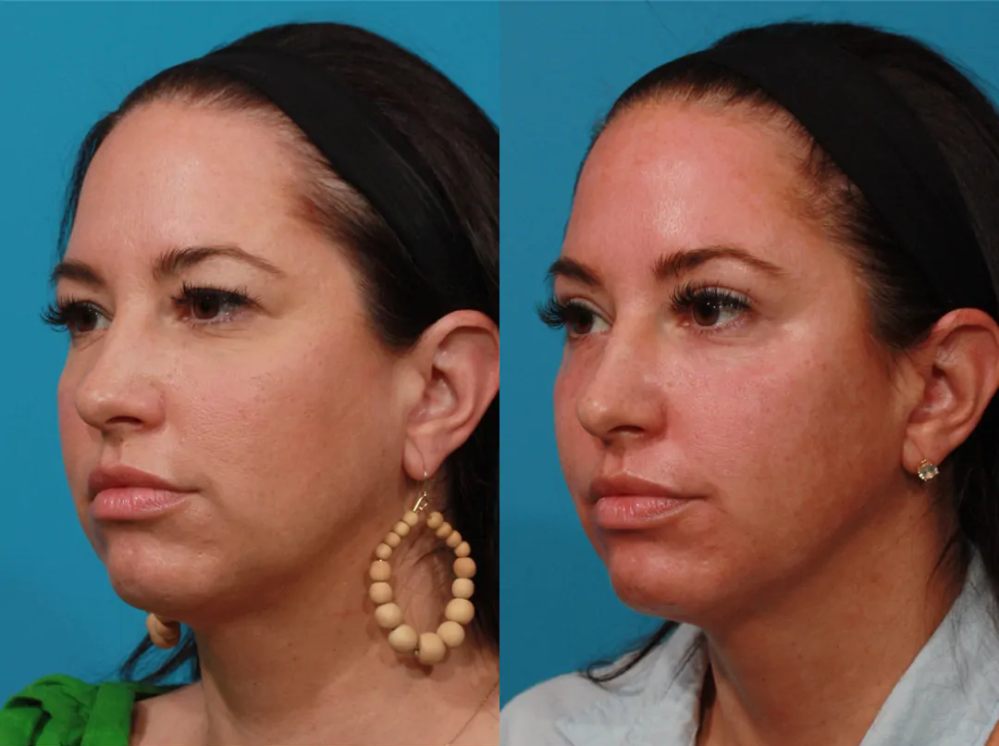 Пациентка пластического хирурга Гукаса Миракяна до и после блефаропластики