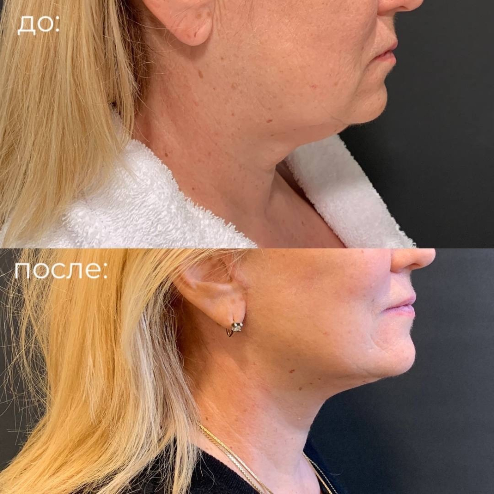 Пациентка пластического хирурга Александра Каткова. Фото до и после омоложения шеи