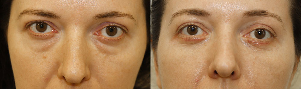 Александр Жуков блефаропластика