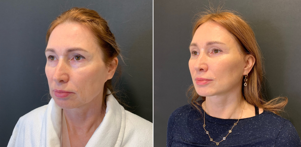 Пациентка пластического хирурга Александра Каткова. Фото до и через два месяца после спейслифтинга лица и эндоскопического лобно-височного лифтинга