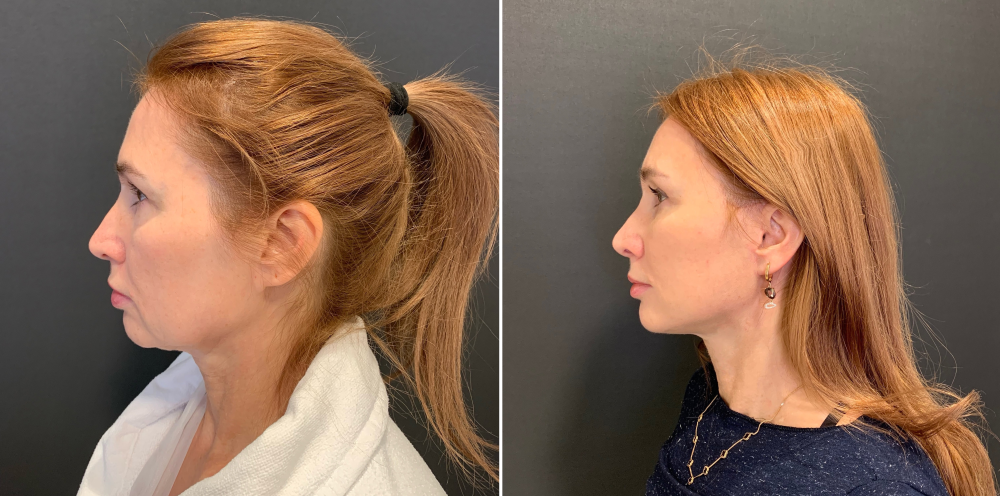 Пациентка пластического хирурга Александра Каткова. Фото до и через два месяца после спейслифтинга и эндоскопического лобно-височного лифтинга лица