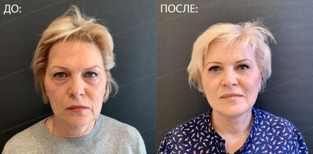 Пациентка пластического хирурга Александра Каткова. Фото до и через два месяца после спейслифтинга и блефаропластики с липофилингом нижних век