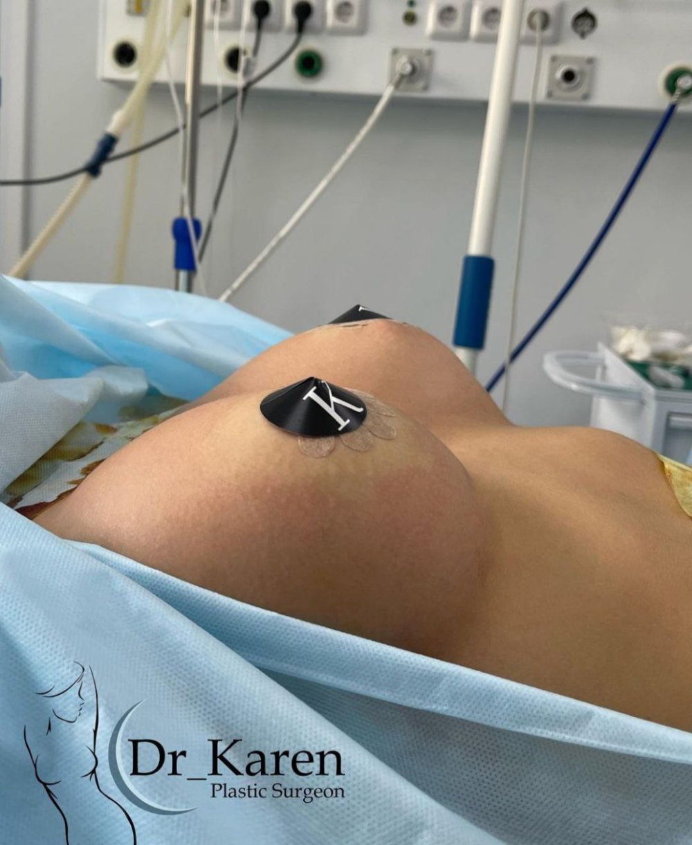 Пациентка пластического хирурга Карена Пайтяна. Результат увеличения сразу после операции