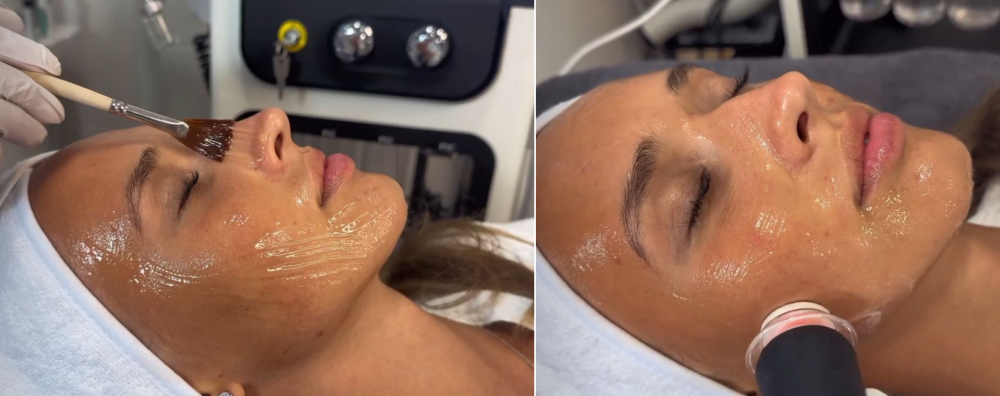 Пациентка клиники NBC во время влажной микрошлифовки HydraBeauty